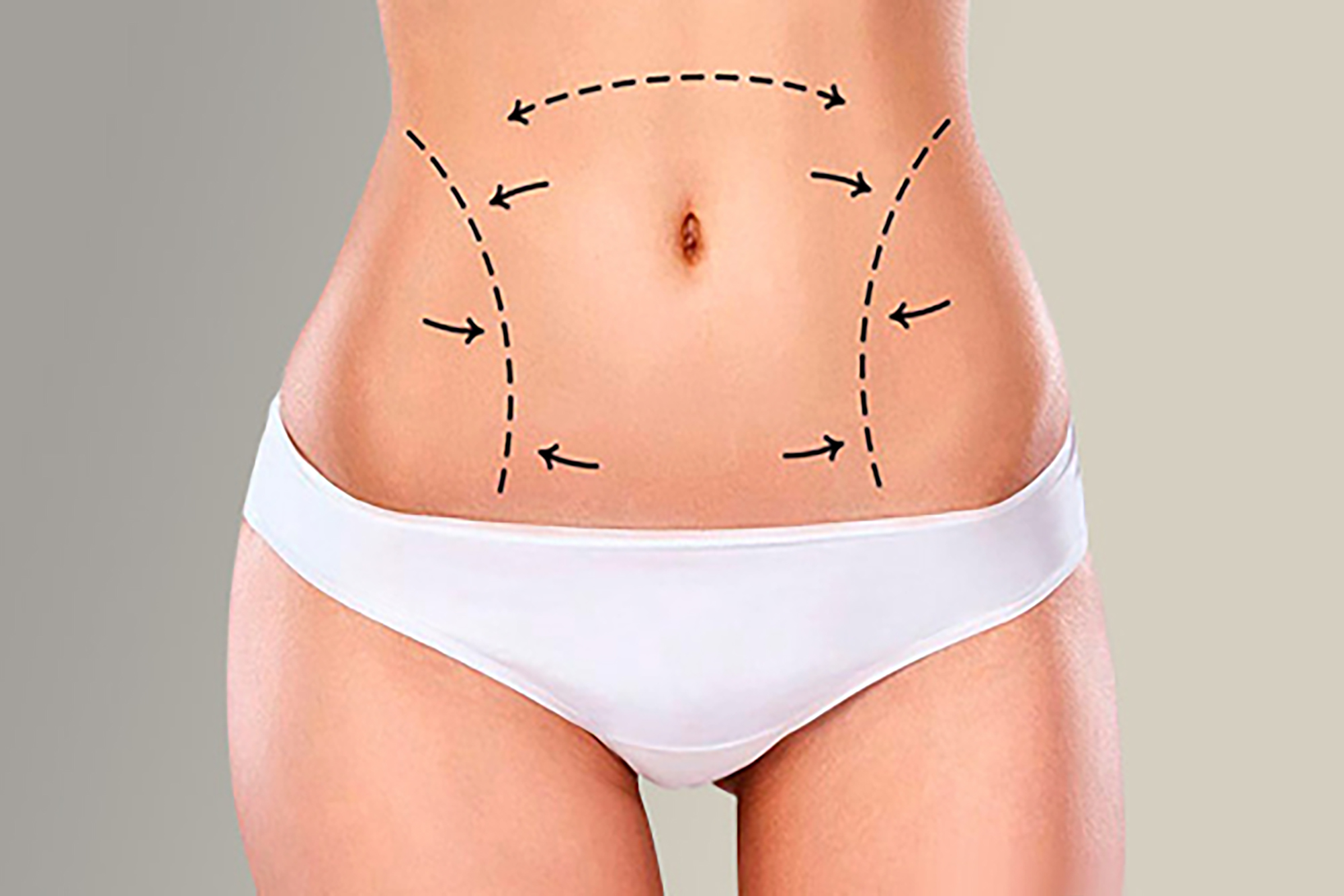 liposuction-izmir-68 liposuction-izmir-68