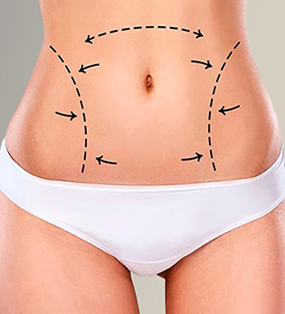 liposuction-izmir-68